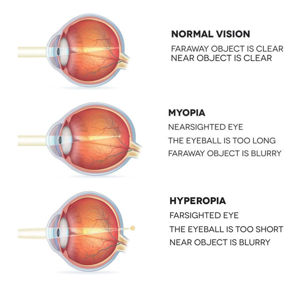 What Is Nearsighted And Farsighted Vision InVision Optical