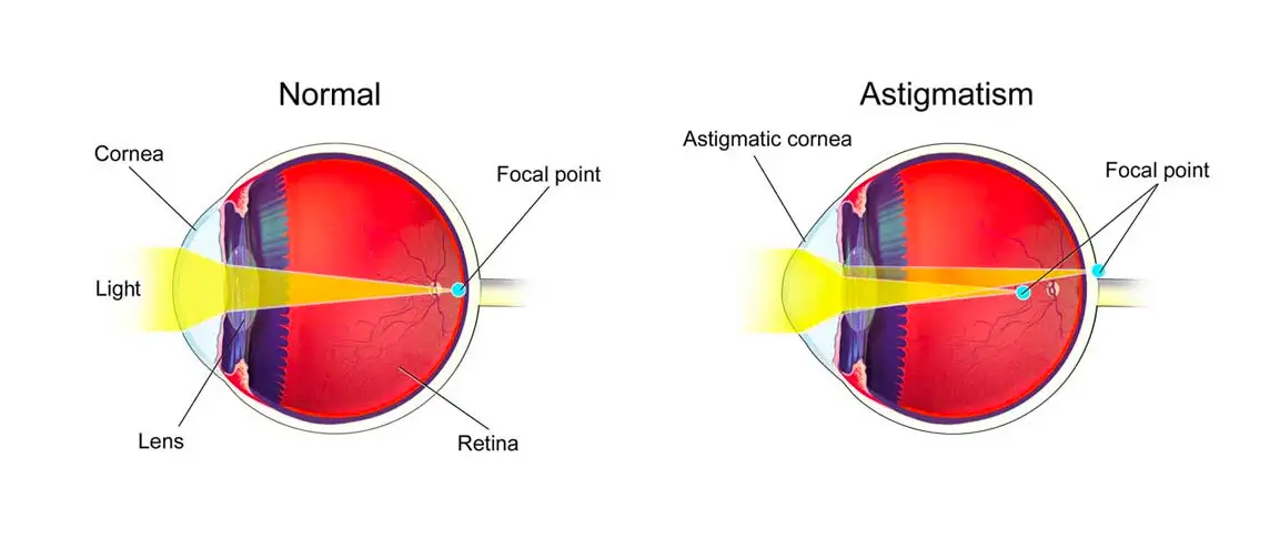 Understanding Your Vision Prescription - InVision Optical